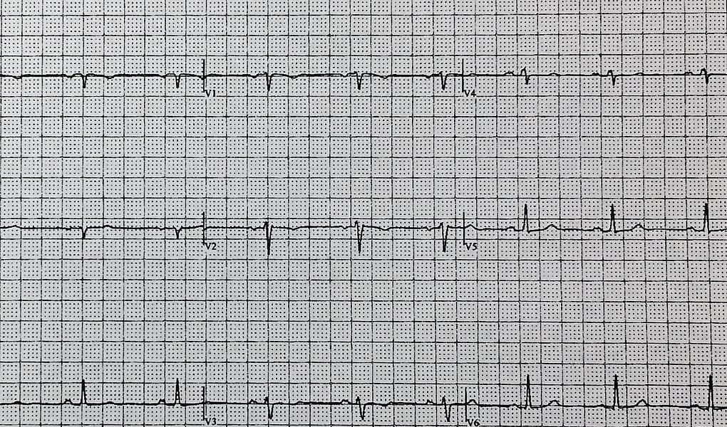 Printed paperwork from my cardiologist showing the rhythm of my heart beat
