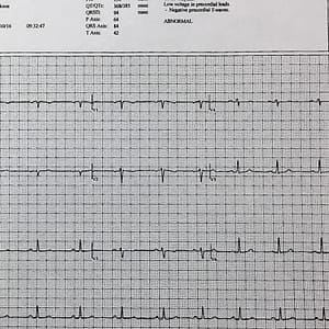 Printed paperwork from my cardiologist showing the rhythm of my heart beat