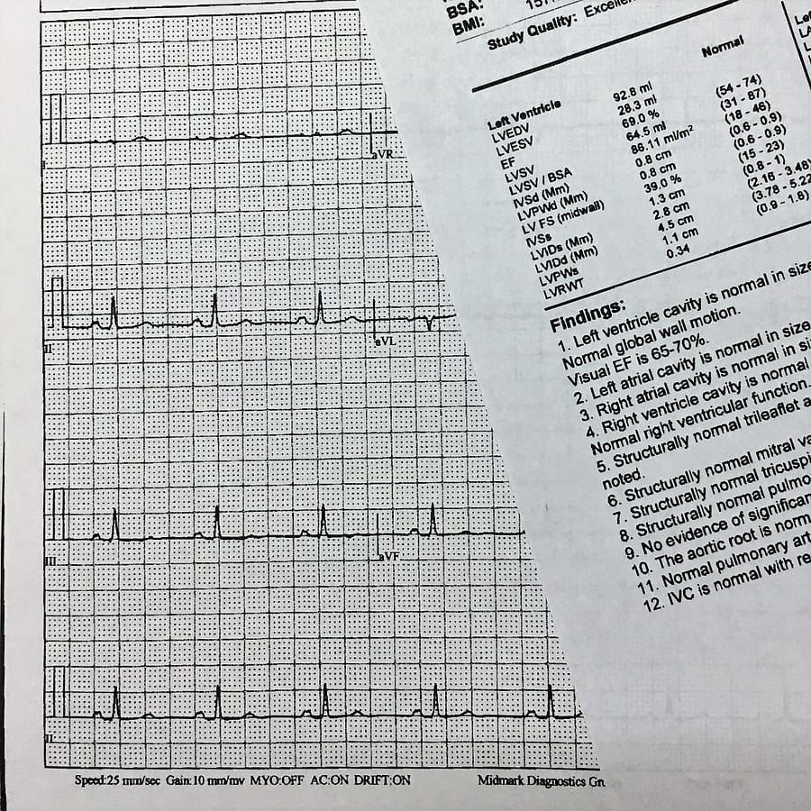 Printed paperwork from my cardiologist showing the rhythm of my heart beat